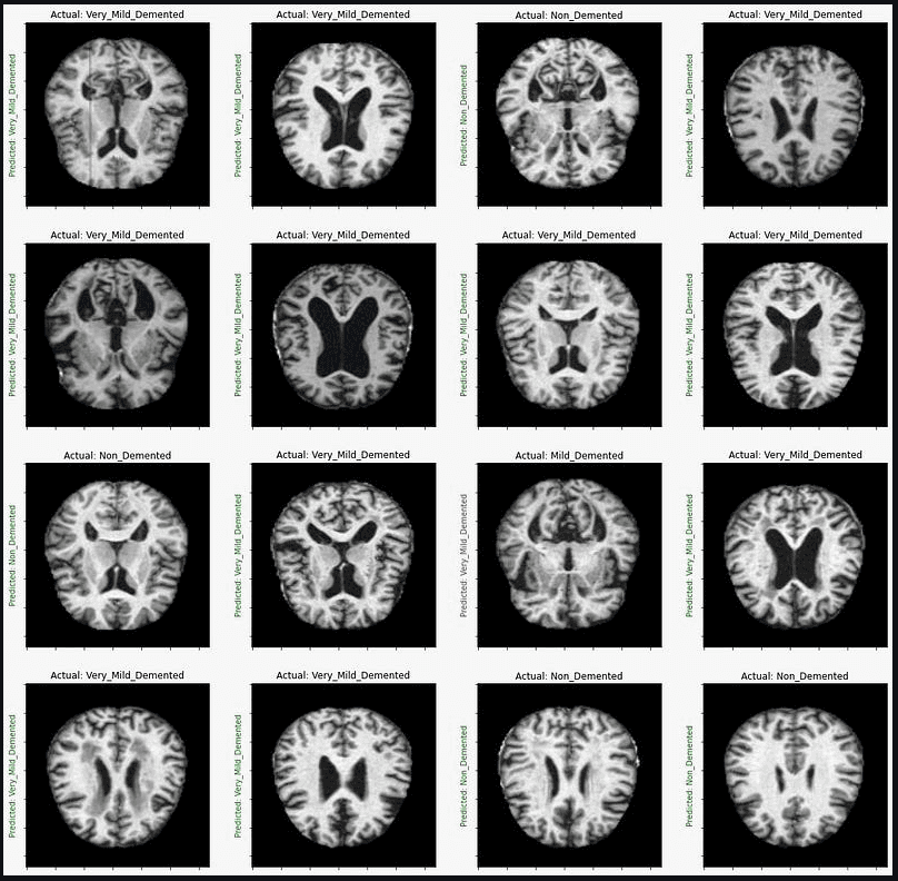 Deep Learning for Dementia screenshot 2